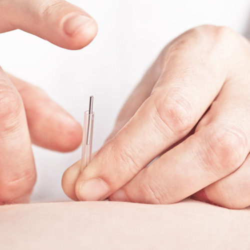 Punción Seca Punción Seca